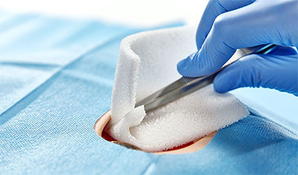 The hydrophilic debridement foam is well suited for cleaning deep and hard-to-reach wounds. © 2021 Freudenberg The hydrophilic debridement foam is well suited for cleaning deep and hard-to-reach wounds. © 2021 Freudenberg
