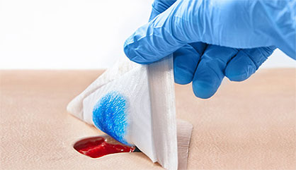 Freudenberg PU foams with directly applied silicone adhesives are more flexible and adapt better to the wound bed. This photo shows a bordered dressing. © 2021 Freudenberg Freudenberg PU foams with directly applied silicone adhesives are more flexible and adapt better to the wound bed. This photo shows a bordered dressing. © 2021 Freudenberg